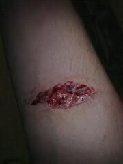 My Fore-Arm 5yrs Ago